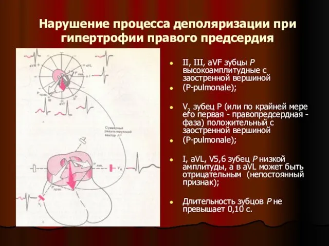 Нарушение процесса деполяризации при гипертрофии правого предсердия II, III, aVF