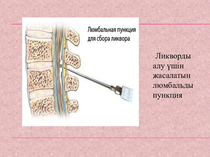 Ликворды алу үшін жасалатын люмбальды пункция