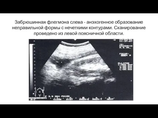 Забрюшинная флегмона слева - анэхогенное образование неправильной формы с нечеткими