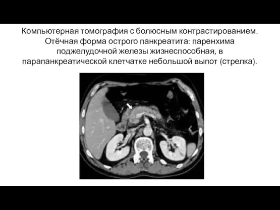 Компьютерная томография с болюсным контрастированием. Отёчная форма острого панкреатита: паренхима