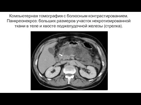 Компьютерная томография с болюсным контрастированием. Панкреонекроз: больших размеров участок некротизированной