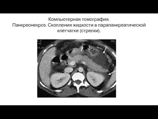 Компьютерная томография. Панкреонекроз. Скопления жидкости в парапанкреатической клетчатке (стрелки).