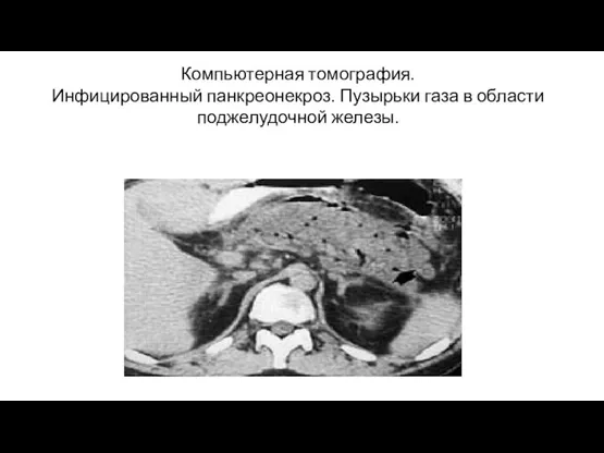 Компьютерная томография. Инфицированный панкреонекроз. Пузырьки газа в области поджелудочной железы.