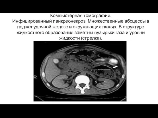Компьютерная томография. Инфицированный панкреонекроз. Множественные абсцессы в поджелудочной железе и