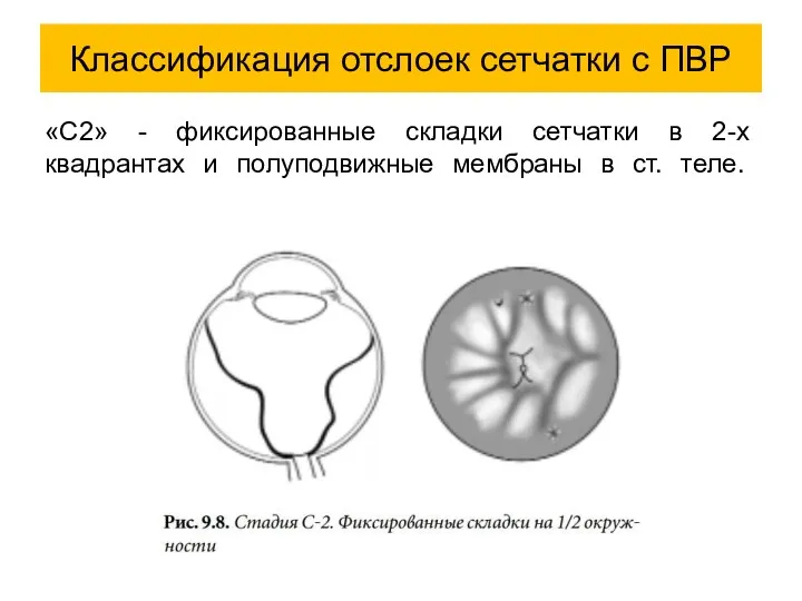 «С2» - фиксированные складки сетчатки в 2-х квадрантах и полуподвижные