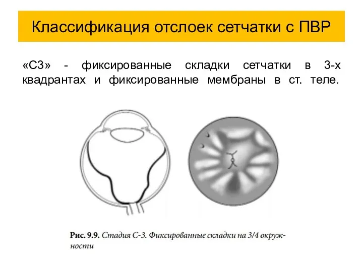 «С3» - фиксированные складки сетчатки в 3-х квадрантах и фиксированные