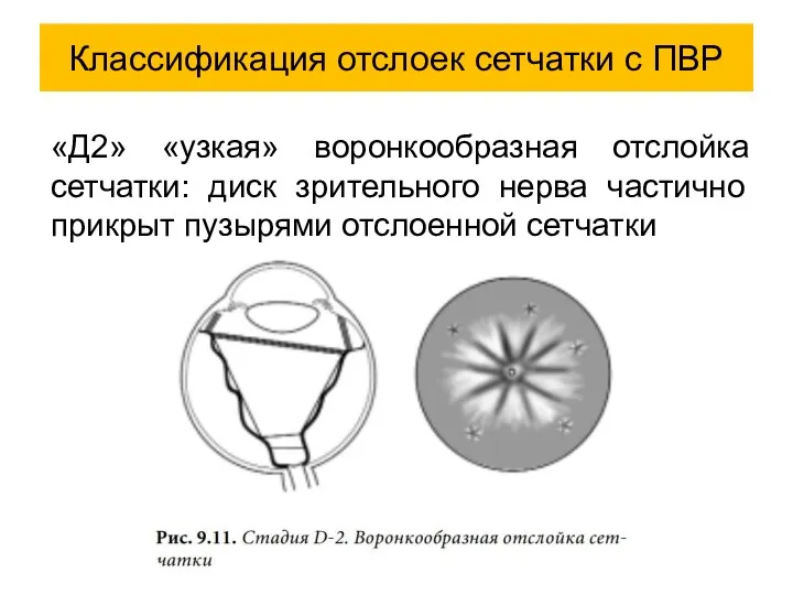 «Д2» «узкая» воронкообразная отслойка сетчатки: диск зрительного нерва частично прикрыт