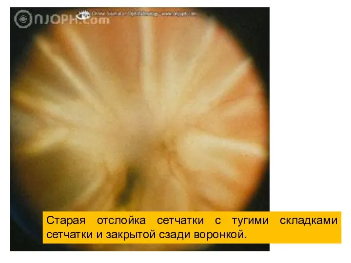 Старая отслойка сетчатки с тугими складками сетчатки и закрытой сзади воронкой.