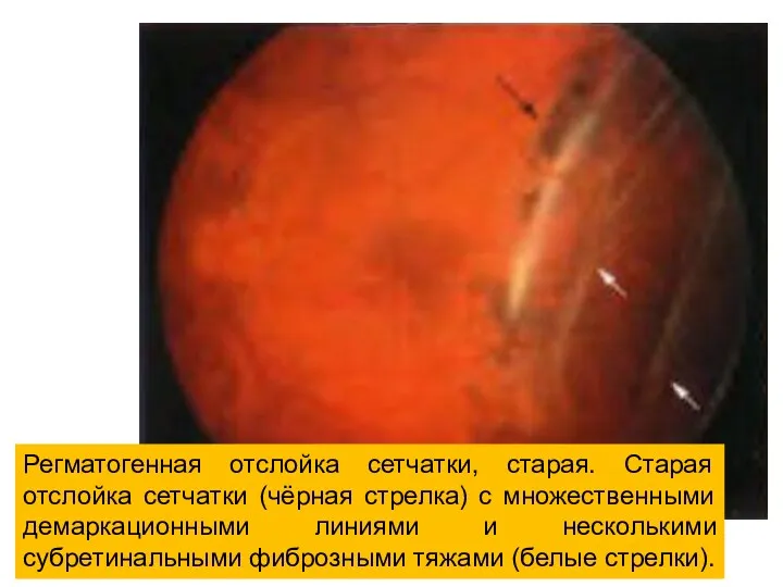 Регматогенная отслойка сетчатки, старая. Старая отслойка сетчатки (чёрная стрелка) с