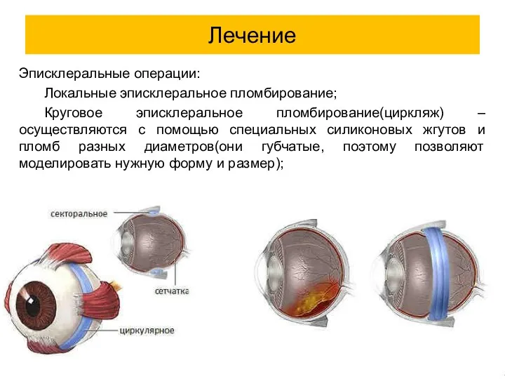 Эписклеральные операции: Локальные эписклеральное пломбирование; Круговое эписклеральное пломбирование(циркляж) – осуществляются