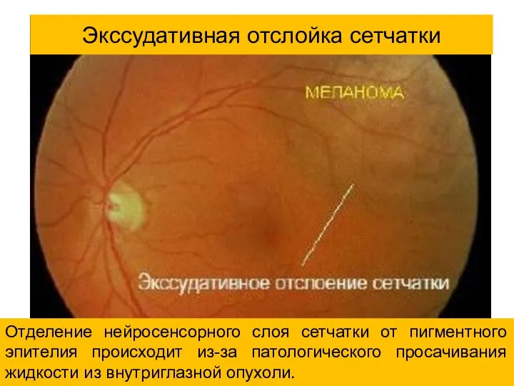 Экссудативная отслойка сетчатки Отделение нейросенсорного слоя сетчатки от пигментного эпителия