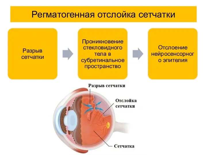 Регматогенная отслойка сетчатки