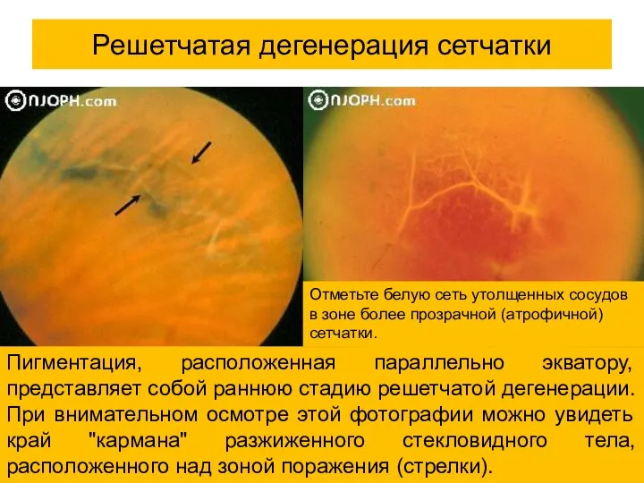 Пигментация, расположенная параллельно экватору, представляет собой раннюю стадию решетчатой дегенерации.