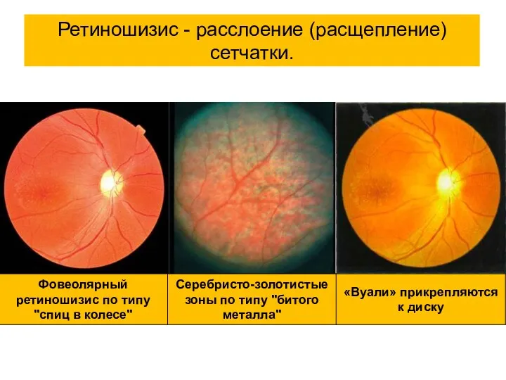 Ретиношизис - расслоение (расщепление) сетчатки.