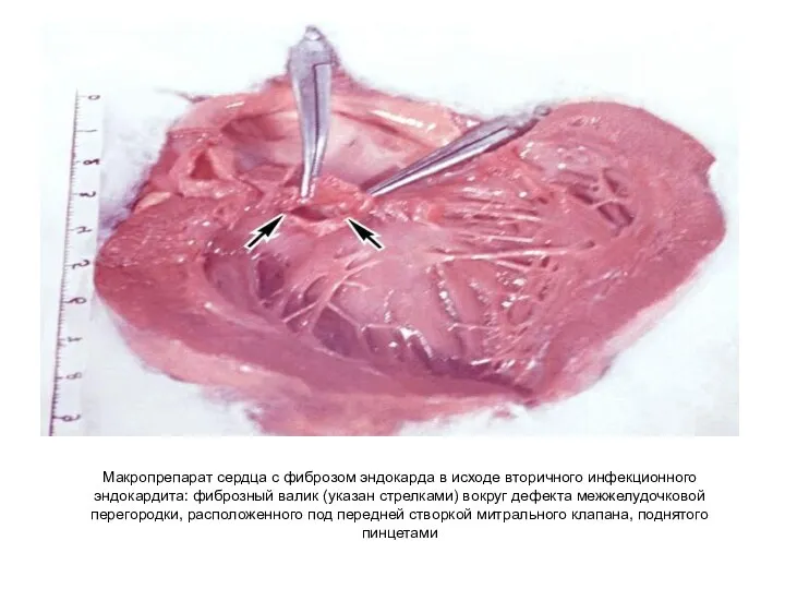 Макропрепарат сердца с фиброзом эндокарда в исходе вторичного инфекционного эндокардита:
