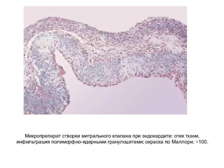 Микропрепарат створки митрального клапана при эндокардите: отек ткани, инфильтрация полиморфно-ядерными гранулоцитами; окраска по Маллори; ×100.