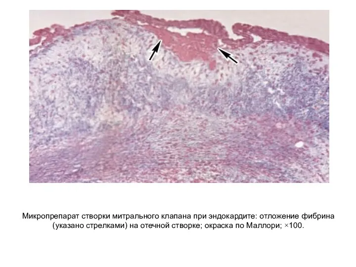 Микропрепарат створки митрального клапана при эндокардите: отложение фибрина (указано стрелками)