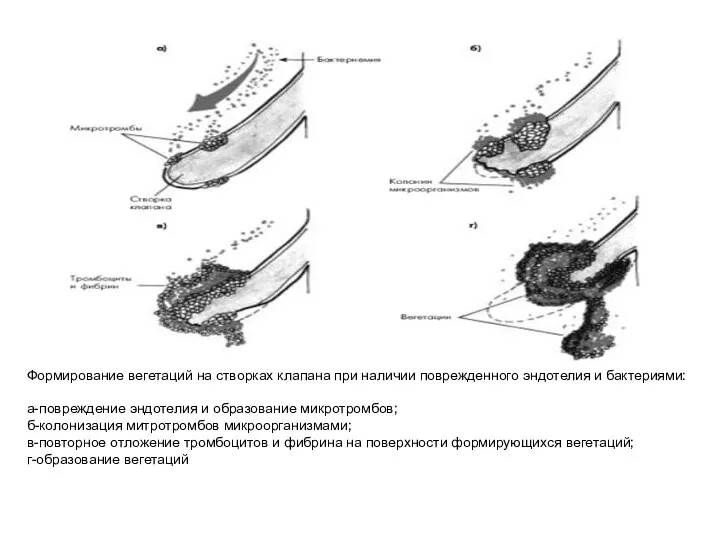 Формирование вегетаций на створках клапана при наличии поврежденного эндотелия и