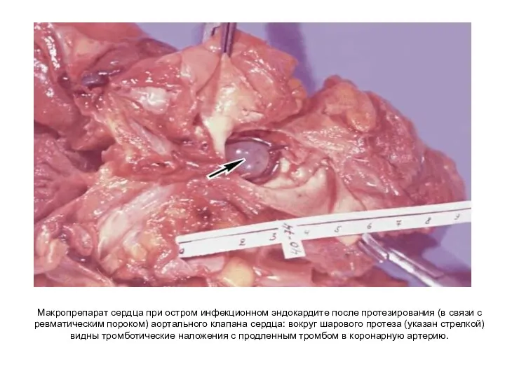 Макропрепарат сердца при остром инфекционном эндокардите после протезирования (в связи