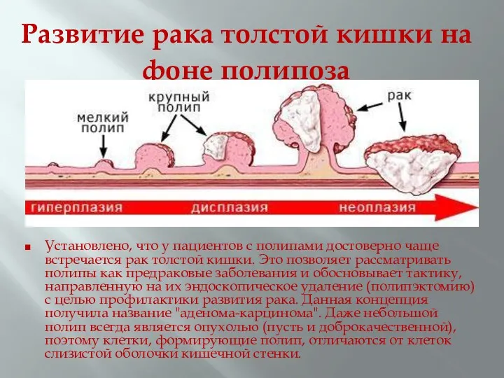 Развитие рака толстой кишки на фоне полипоза Установлено, что у