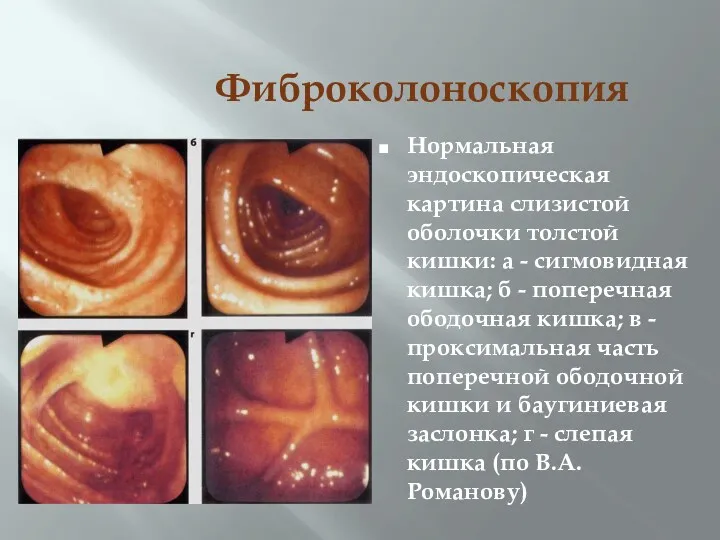 Фиброколоноскопия Нормальная эндоскопическая картина слизистой оболочки толстой кишки: а -