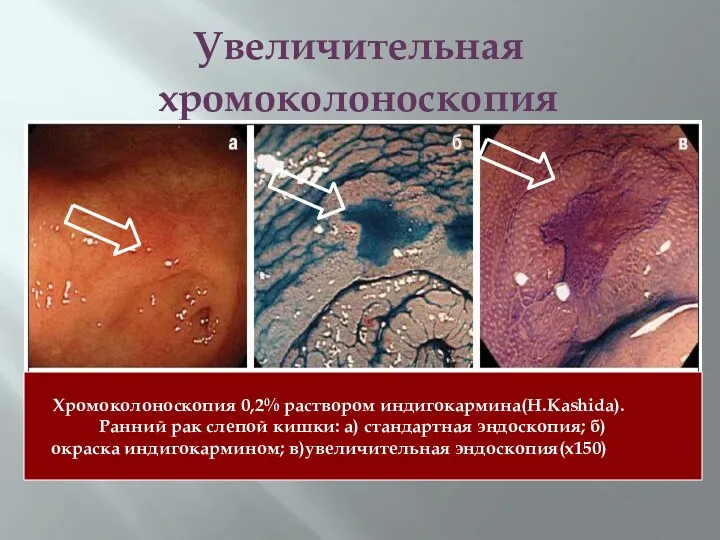 Увеличительная хромоколоноскопия Хромоколоноскопия 0,2% раствором индигокармина(H.Kashida). Ранний рак слепой кишки: