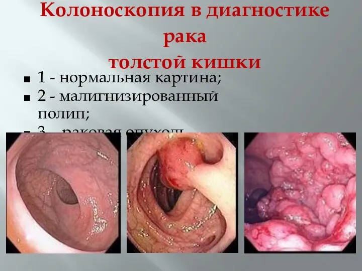 Колоноскопия в диагностике рака толстой кишки 1 - нормальная картина;