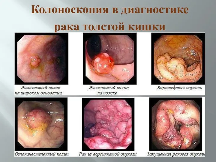 Колоноскопия в диагностике рака толстой кишки