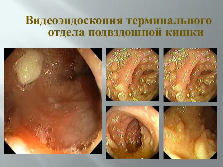 Видеоэндоскопия терминального отдела подвздошной кишки