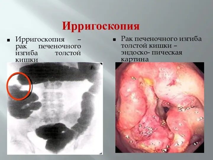 Ирригоскопия Ирригоскопия – рак печеночного изгиба толстой кишки Рак печеночного