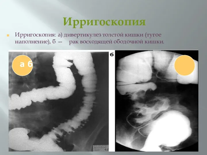 Ирригоскопия Ирригоскопия: а) дивертикулез толстой кишки (тугое наполнение), б — рак восходящей ободочной кишки. а б