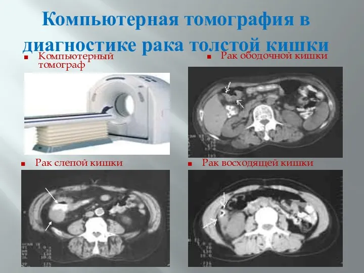 Компьютерная томография в диагностике рака толстой кишки Компьютерный томограф Рак