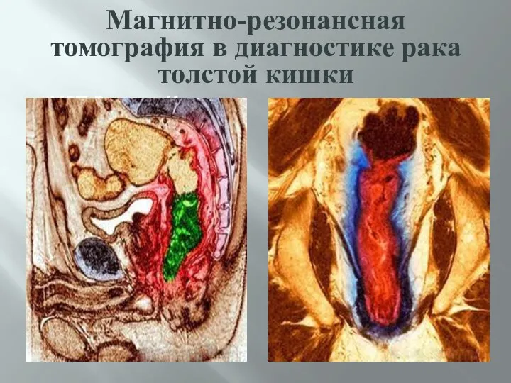 Магнитно-резонансная томография в диагностике рака толстой кишки МРТ Р.толст.К