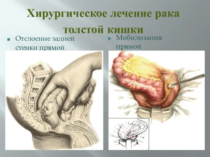 Хирургическое лечение рака толстой кишки Отслоение задней стенки прямой кишки. Мобилизация прямой кишки