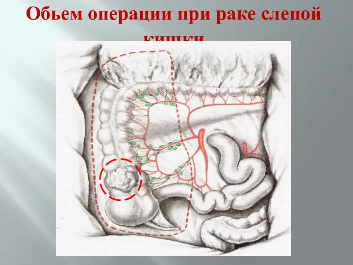 Обьем операции при раке слепой кишки