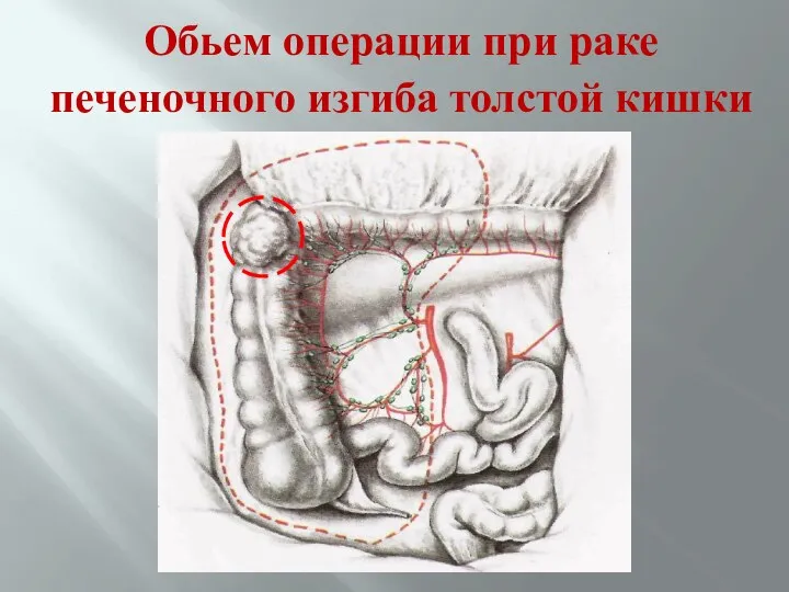 Обьем операции при раке печеночного изгиба толстой кишки