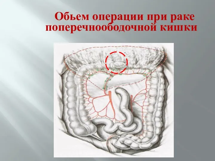 Обьем операции при раке поперечноободочной кишки