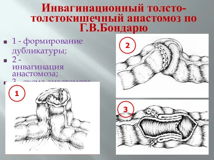 Инвагинационный толсто- толстокишечный анастомоз по Г.В.Бондарю 1 - формирование дубликатуры;