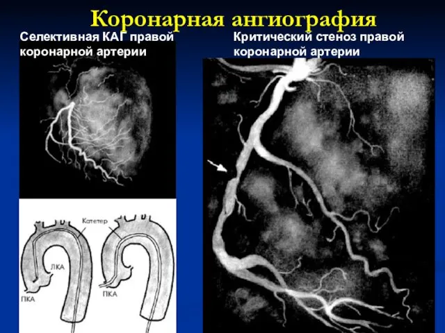 Селективная КАГ правой коронарной артерии Критический стеноз правой коронарной артерии Коронарная ангиография