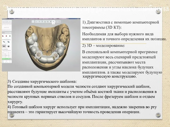 Этапы изготовления хирургического шаблона 1) Диагностика с помощью компьютерной томограммы