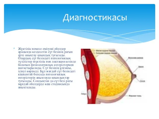 Диагностикасы Жүктілік немесе емізуші әйелдер арасында кездесетін сүт безінің рагын