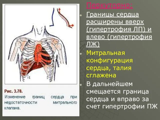 Перкуторно: Границы сердца расширены вверх (гипертрофия ЛП) и влево (гипертрофия ЛЖ) Митральная конфигурация