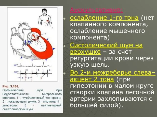 Аускультативно: ослабление 1-го тона (нет клапанного компонента, ослабление мышечного компонента)