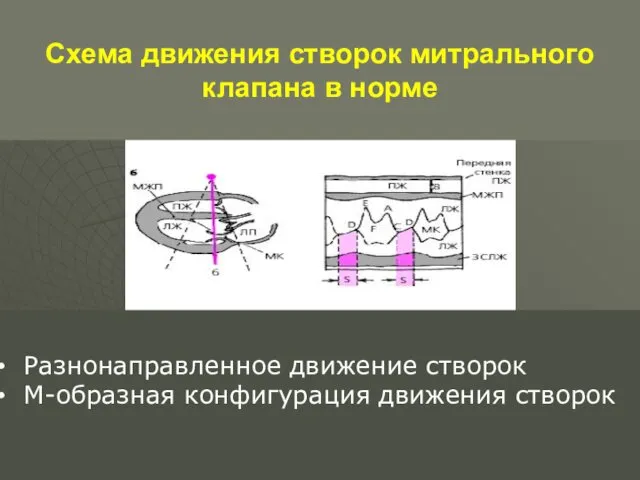 Схема движения створок митрального клапана в норме Разнонаправленное движение створок М-образная конфигурация движения створок