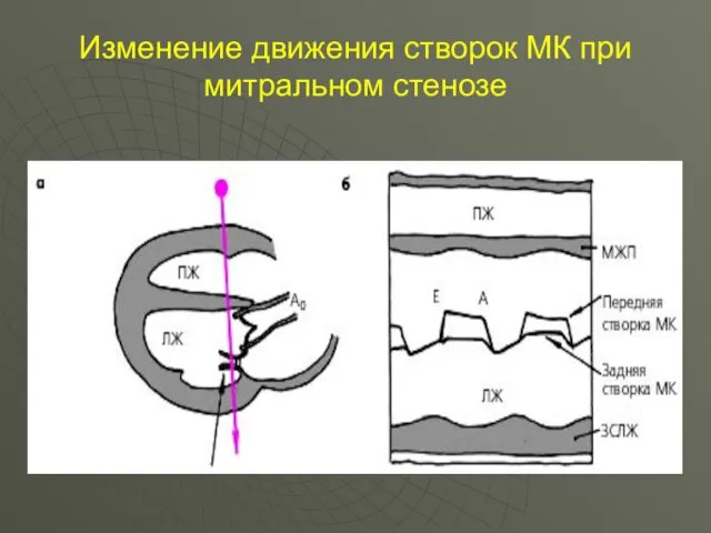 Изменение движения створок МК при митральном стенозе