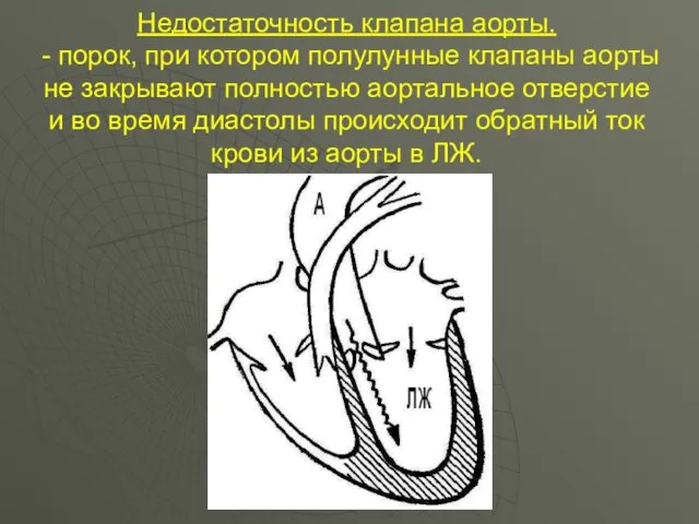 Недостаточность клапана аорты. - порок, при котором полулунные клапаны аорты не закрывают полностью