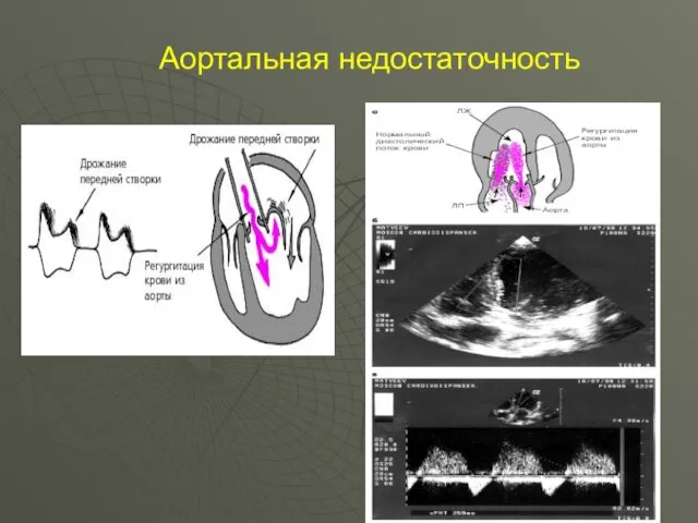 Аортальная недостаточность