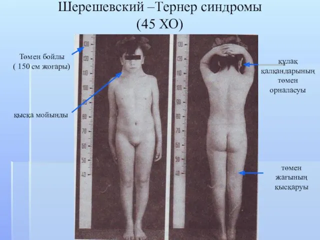 Шерешевский –Тернер синдромы (45 ХО) Төмен бойлы ( 150 см жоғары) қысқа мойынды