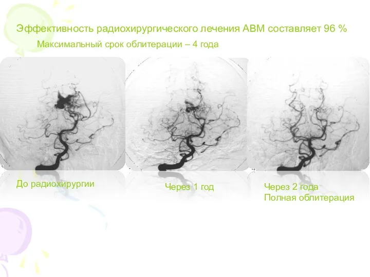 Эффективность радиохирургического лечения АВМ составляет 96 % Через 1 год