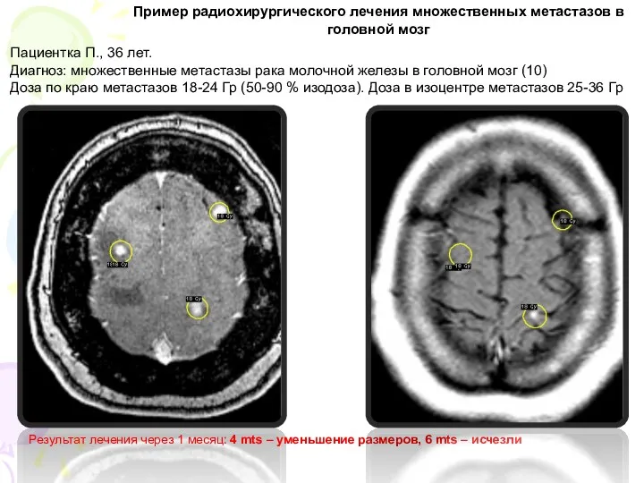 Результат лечения через 1 месяц: 4 mts – уменьшение размеров,